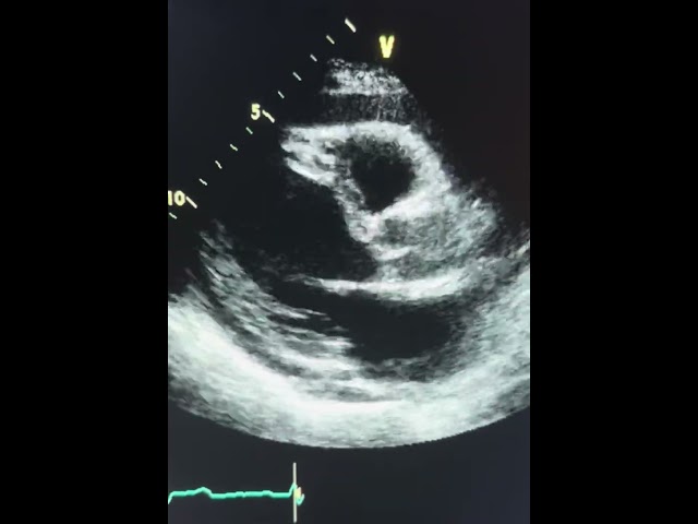 Parasternal Echocardiogram showing evidence of Right Ventricle Collapse from Cardiac Tamponade