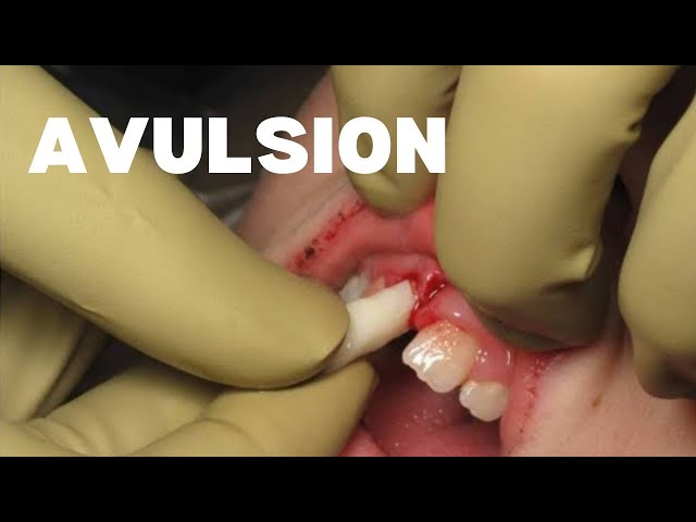 Avulsion Tooth Replantation | Step by Step Guide