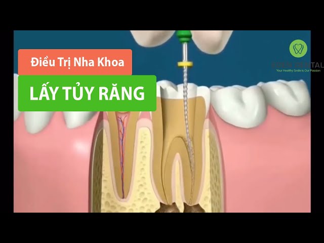 Quy trình điều trị Lấy Tủy Răng - Root Canal Treatment - Eden Dental