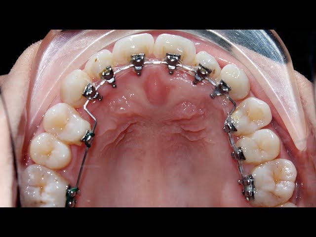 Niềng răng mặt trong (không thấy mắc cài) #orthodontist