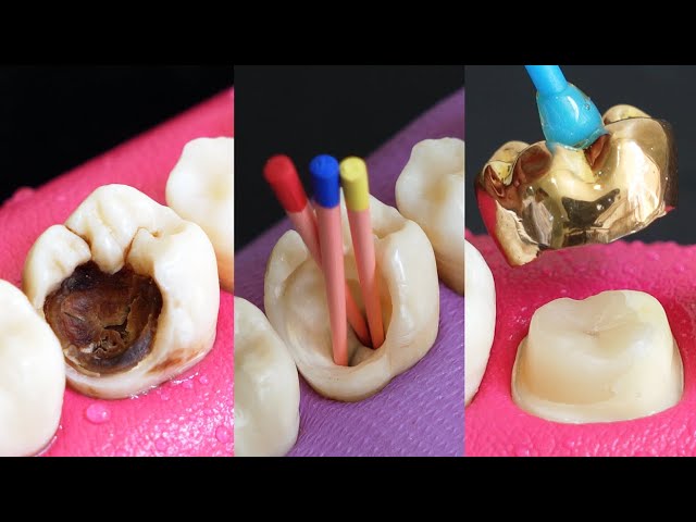 Classic Restoration Of Decayed Tooth By Root Canal And Gold Crown.