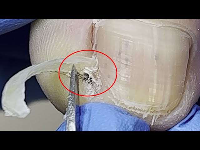 Ingrown nails and meat stick together, separate carefully!【Xue Yidao】