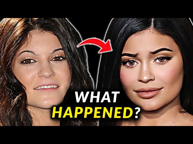 Kylie Jenner's Face - Before and After