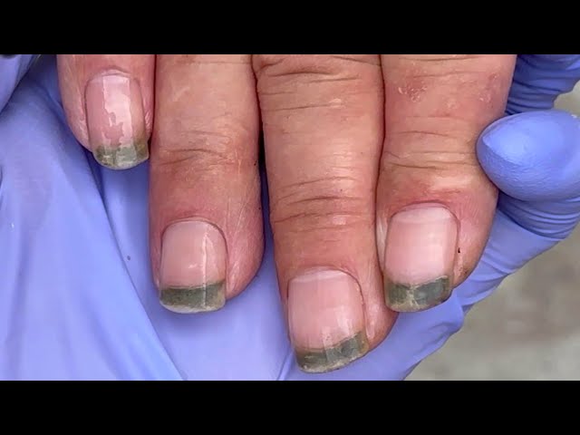 Dirty nails! There is a pile of black mud between the nails【Doctor Liu Pedicure】