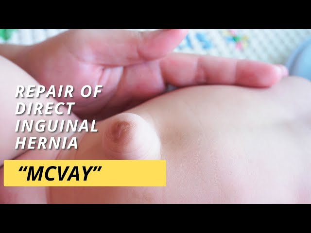 Repair of Direct Inguinal Hernia (McVay) #myyearonyoutube!