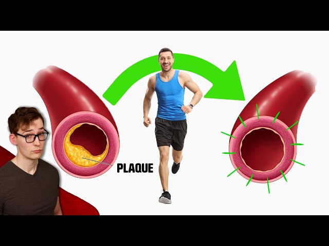 Exercise shrinks Plaque, but it does more than that…