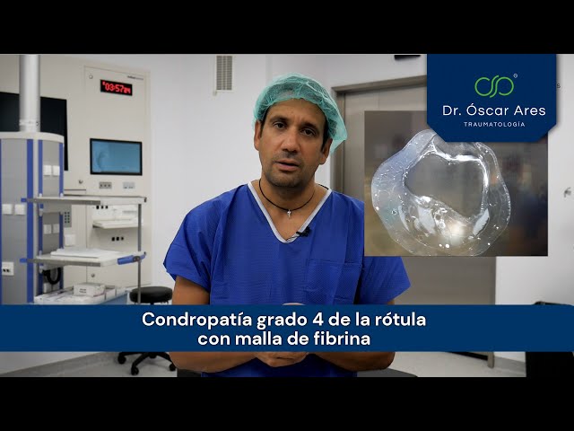 Condropatía grado 4 de la rótula con malla de fibrina - Dr. Ares