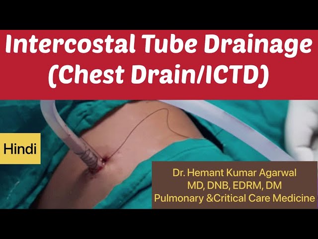 Intercostal Tube Drainage-A Live Demonstration in Patient (Hindi) (Chest Drain/ ICTD) # Chest Tube