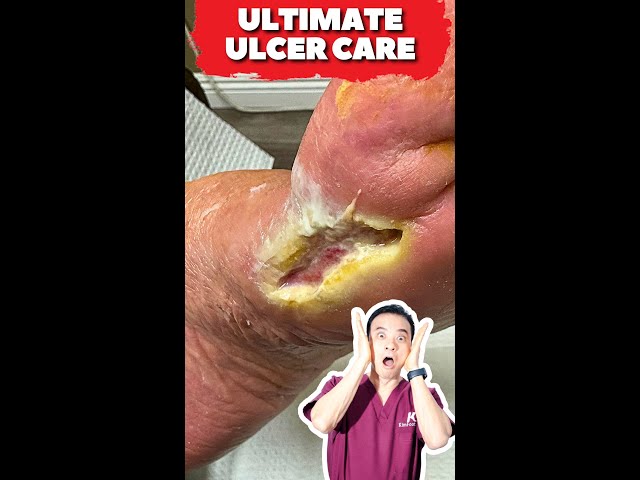 Ultimate Wound Care: Diabetic Ulcer Grafting Transformation!