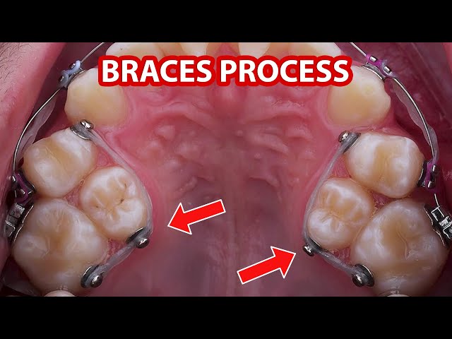 Braces process (2 year)