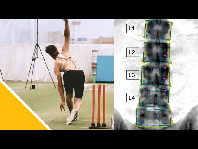 Cricket Fast Bowling and the Lumbar Spine | Dr Pete Alway