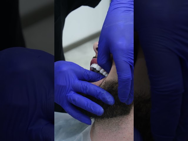 Zirconia Crown Preparation Procedure  #shortsvideo #dentaltreatments #zirconiacrown #beforeafter