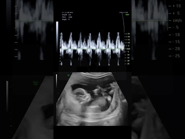 This is What a Baby's Heartbeat Sounds Like During an Ultrasound #science #natal #shorts