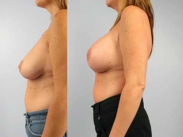 Breast Augmentation at Allure Medical Spa | Dr. Charles Mok