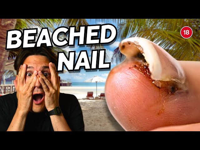 Toenail Removal After Beach Injury: Step-by-Step Procedure & Care Tips