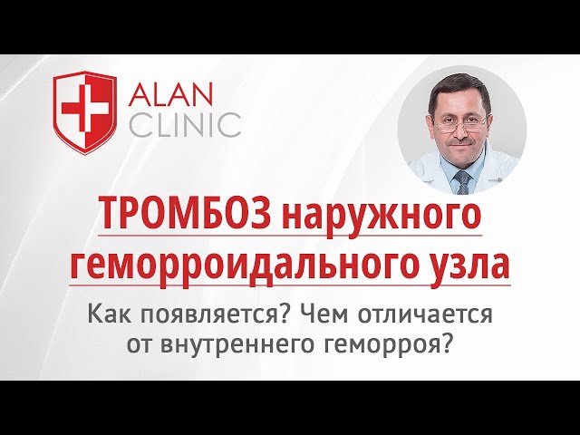 Тромбоз наружного геморроидального узла: как появляется, чем отличается от внутреннего геморроя