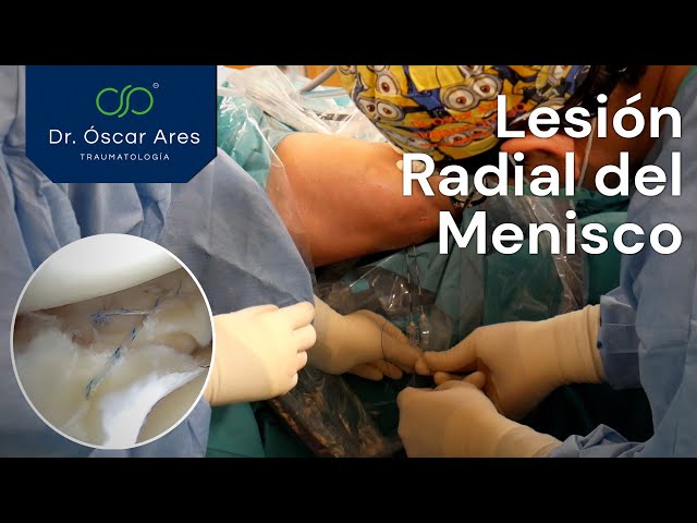 Lesión radial del menisco - Dr. Oscar Ares