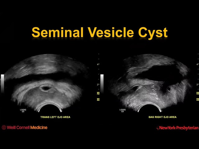 Imaging for Male Infertility and Impotence