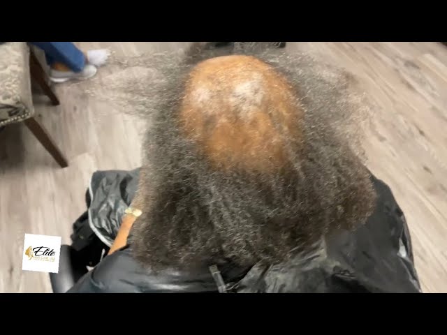 Covering bald spot | scarring alopecia