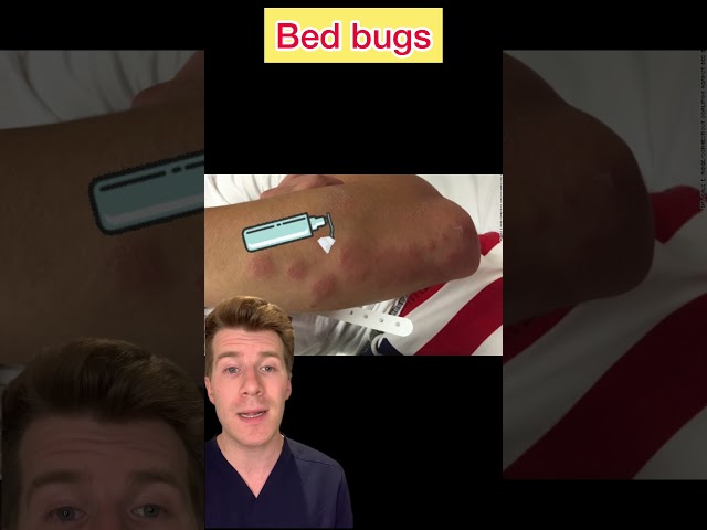 BED BUGS EXPLAINED IN UNDER 60 SECONDS #shorts #medical #doctor #bedbugs