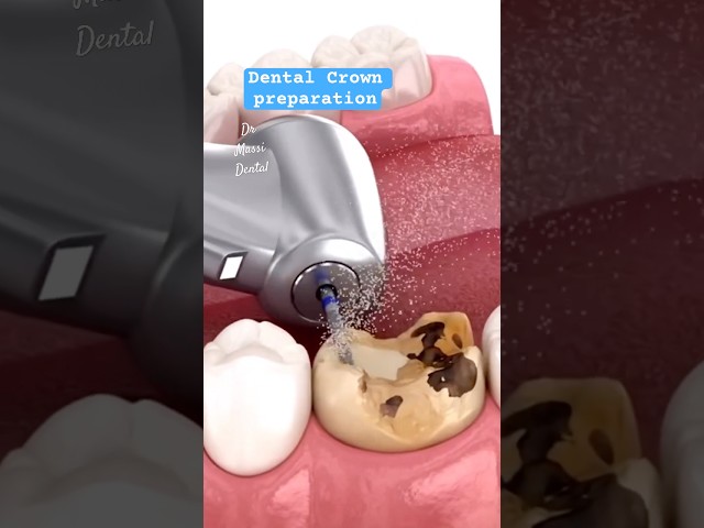 Dental Crown Preparation