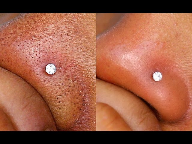 How I remove my Blackheads - Update Queenii Rozenblad