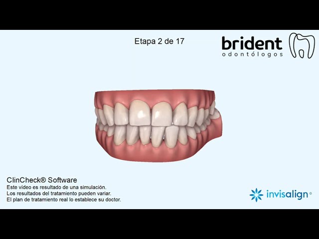 Ortodoncia Invisible Invisalign - Mordida a Borde a Borde