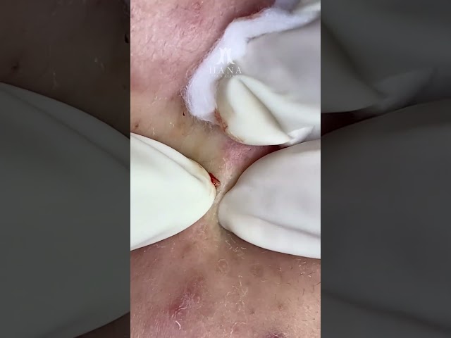 Big Cystic Acne Blackheads Extraction Blackheads & Milia, Whiteheads Removal Pimple Popping #shorts