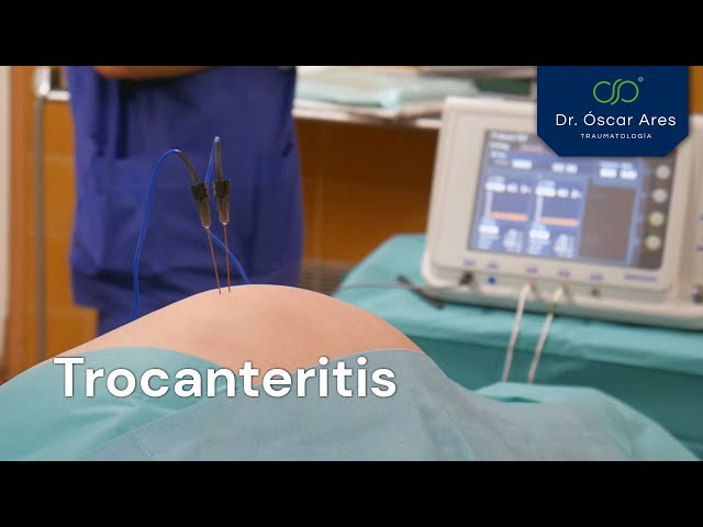 Trocanteritis - Dr. Oscar Ares