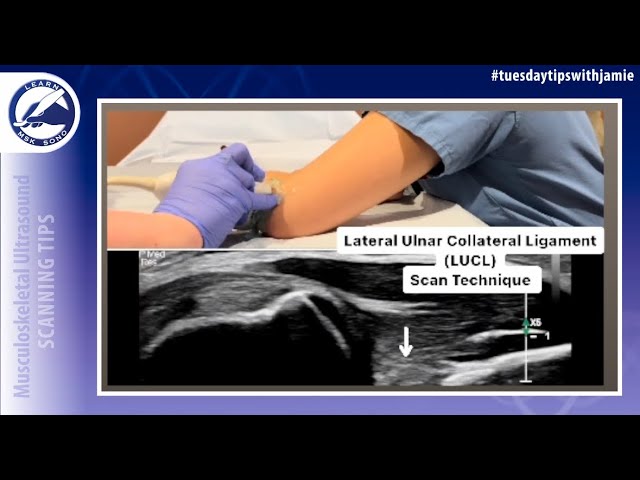 Lateral Ulnar Collateral Ligament of Elbow Scan Technique