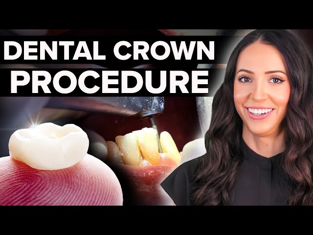 Same Day Dental Crown Procedure Step by Step