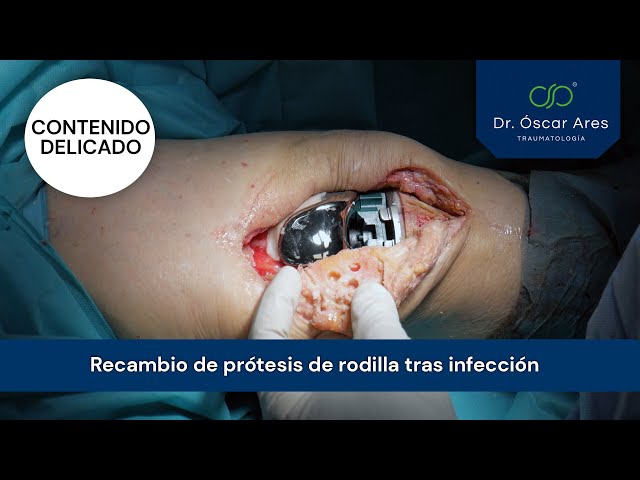 Recambio de prótesis de rodilla tras infección - Dr. Oscar Ares