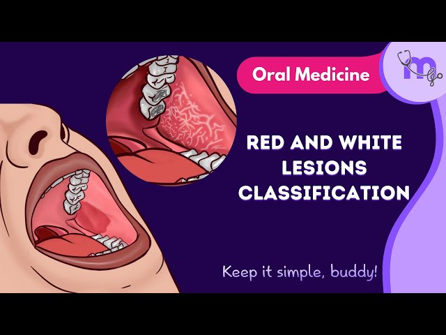 Red and White Lesions Classification  | Full Video | Oral Medicine | Medi Study Go