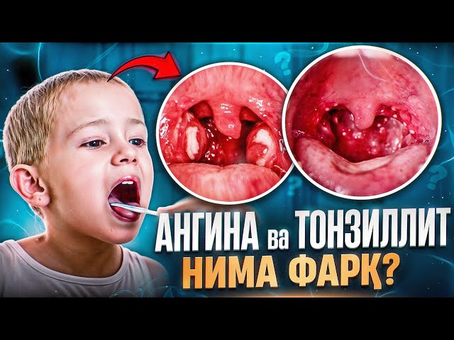 Ангина ёки тонзиллит. Нима фарқ? | Доктор Гулбаҳор