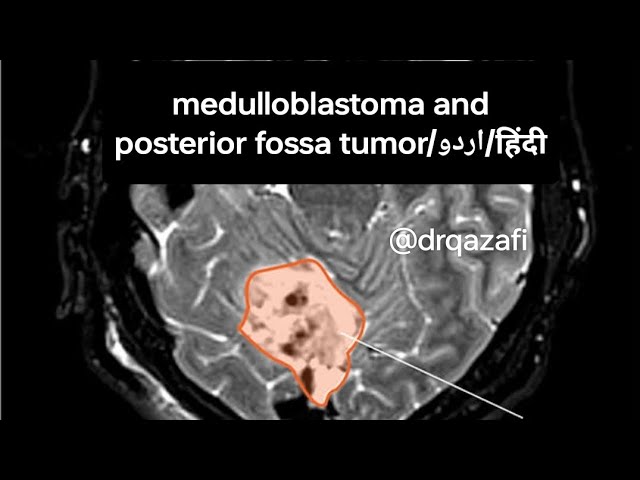 Medulloblastoma and posterior fossa tumor surgery and treatment|اردو| हिंदी|