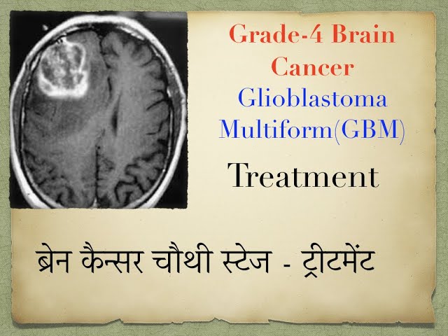 Question & Answer-5 Treatment of Brain Cancer (Glioblastoma Multiform)