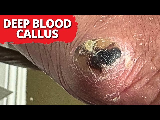 Is A Blood Callus Dangerous?? (Satisfying Debridement)