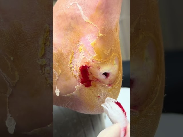 Extreme Diabetic Ulcer Debridement - Satisfying Foot Transformation!