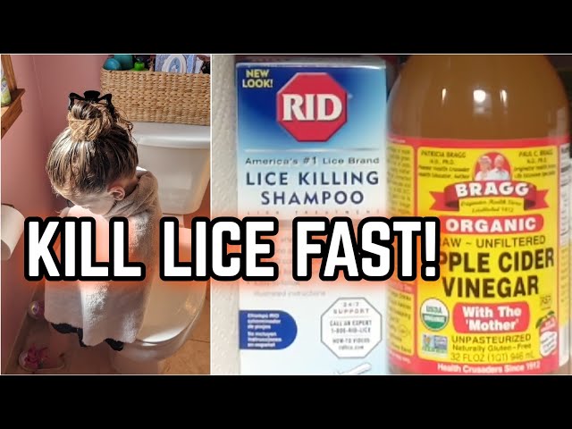 HOW TO GET RID OF LICE FAST!! 😲🦟 AND KEEP IT FROM COMING BACK!!