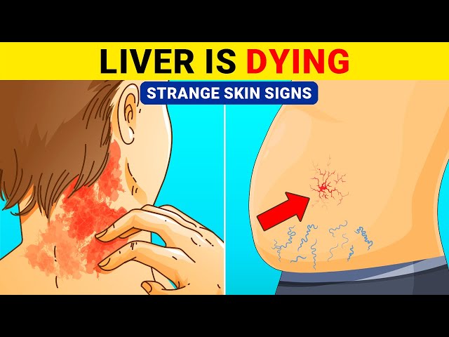 8 Strange Skin Signs Indicating Your Liver Is Damaged