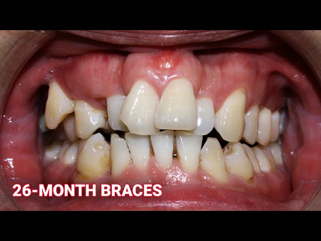 26-Month Braces Journey