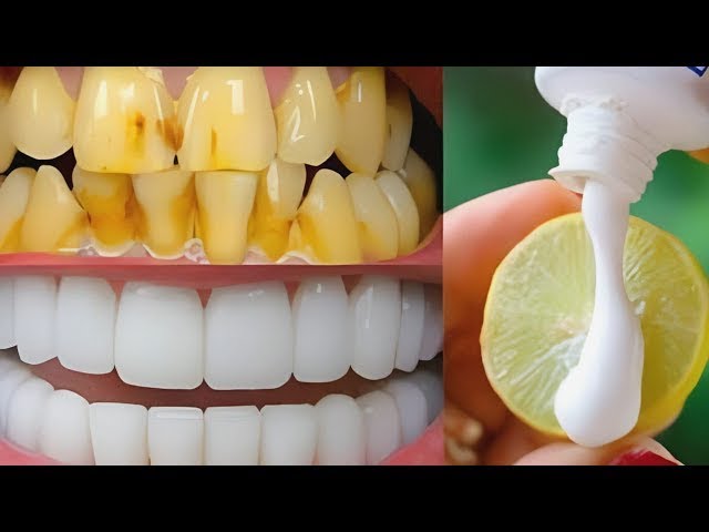 Secret that Dentists don't want you to know: Remove Tartar and Teeth Whitening in just 2 minutes