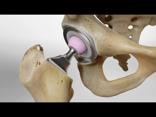 Total Hip Replacement (3D Animation)