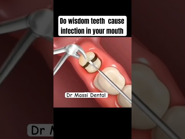 Do wisdom teeth cause infection?