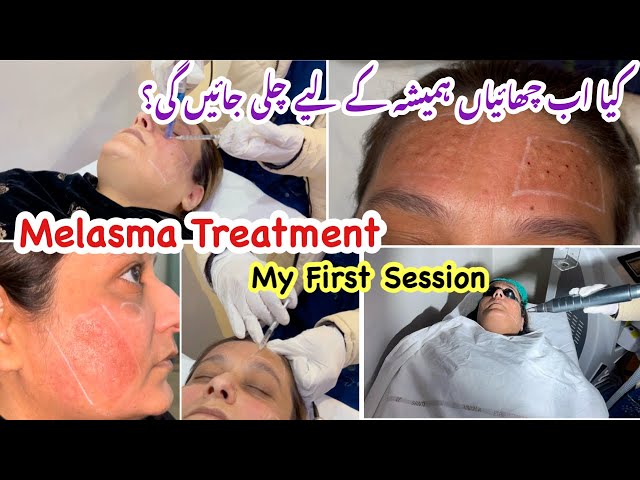 How to treat Melasma|My honest reviews about Mesotherapy|Skin lightening treatment|All about Melasma