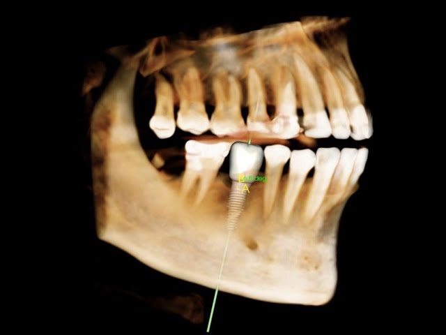 Phẫu thuật implant răng 46  neodent _ Bui Vu Duy Quang 1991