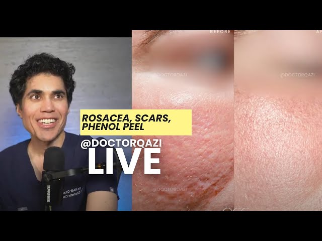 Dr. Qazi discusses Rosacea, Scars, Phenol Peel, Pigmentation | Dr. Qazi Unsponsored Live | 2.10.2025