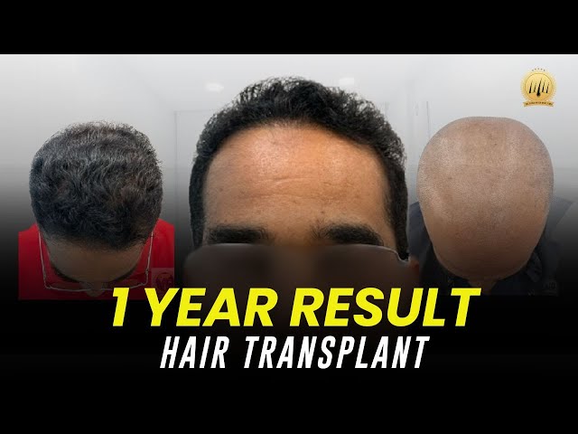 Hair Transplant Malaysia | Tanam Rambut | 1-Year Results & Natural Hairline