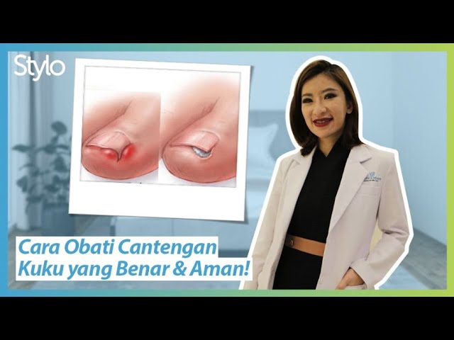 Cara Mengobati Cantengan Kuku Jari Dari Dokter. Pakai Salep Bahan Alami, Yakin Aman? | Stylo.ID