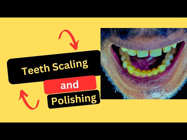 Teeth Scaling and Polishing